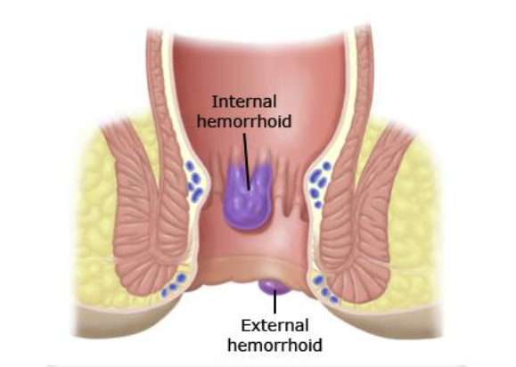 Hemorrhoids