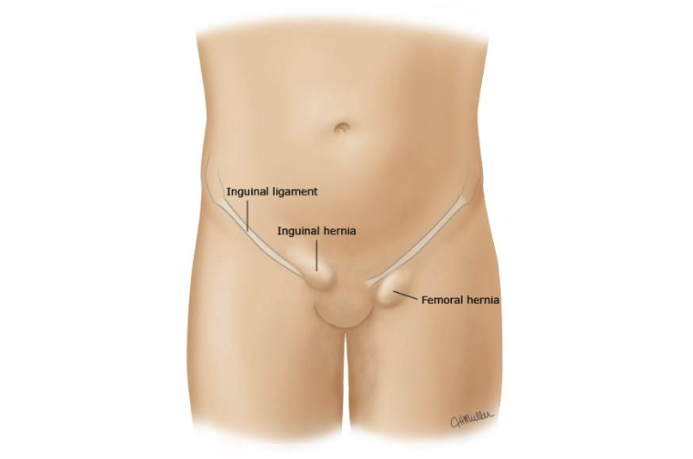 Inguinal Hernia