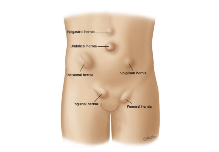 ventral hernia