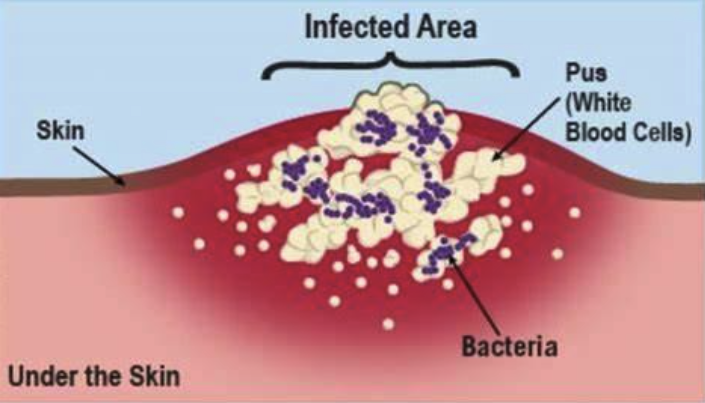 Abscess