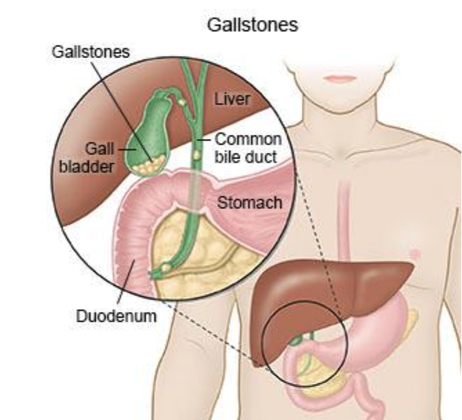 Gallstones