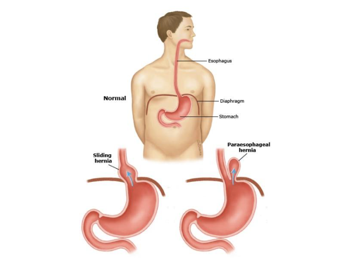 Hiatal Hernia