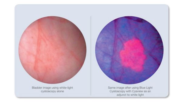 Blue Light Cystoscopy with Cysview®.