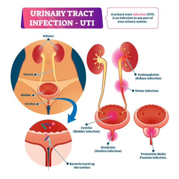 uti diagram