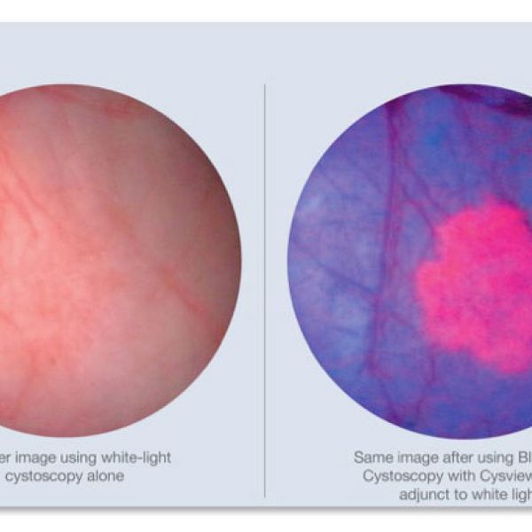 Blue Light Cystoscopy with Cysview®.