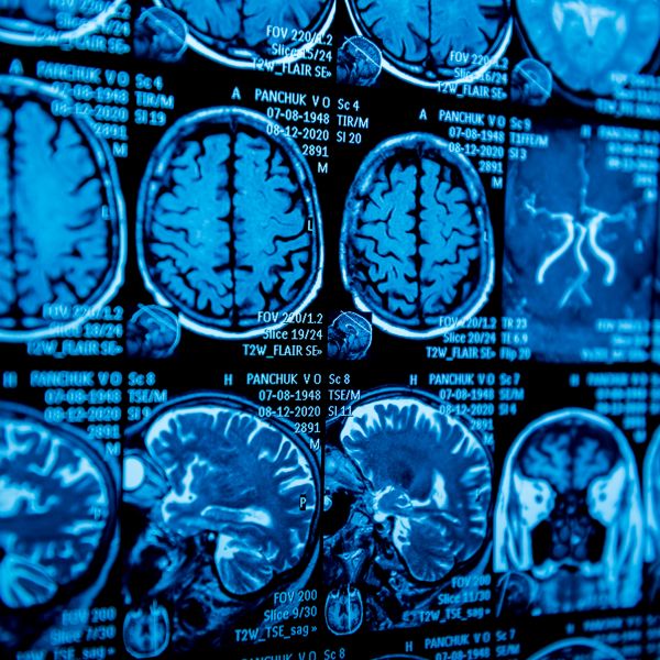 MRI scan of the brain — magnetic resonance imaging scan